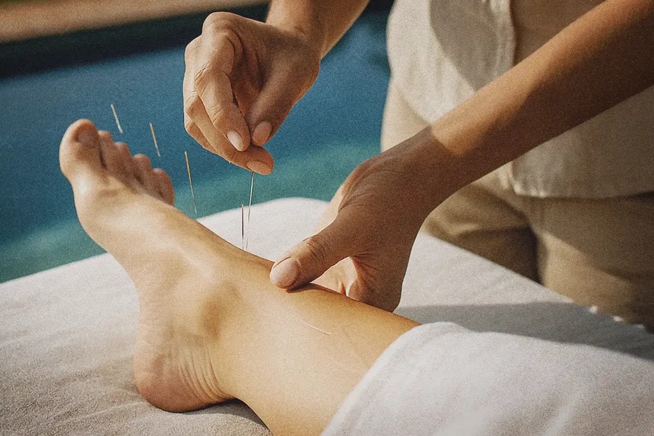 Acupuncture session in Ibiza